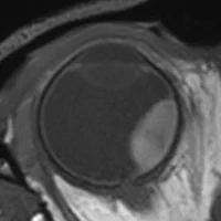 T1-weighted MRI of uveal melanoma
