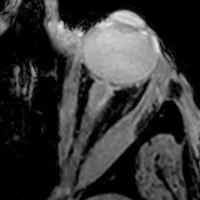 MRI of extraocular eye muscles in myasthenia gravis patient