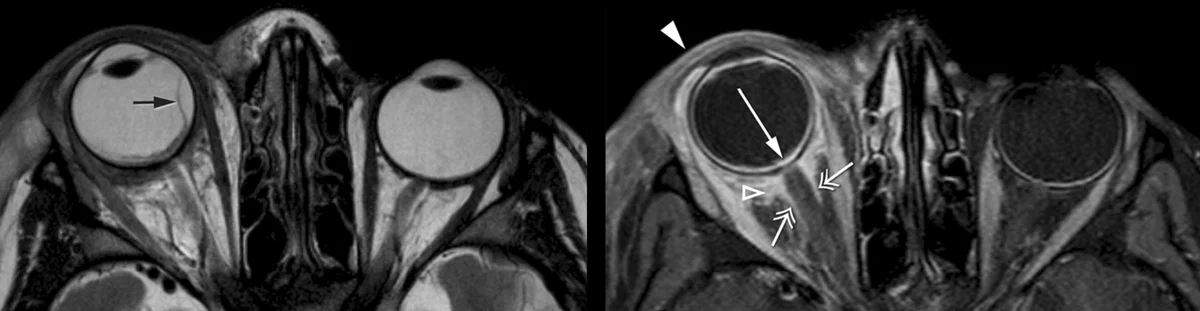 MRI showing orbital inflammation around the eye