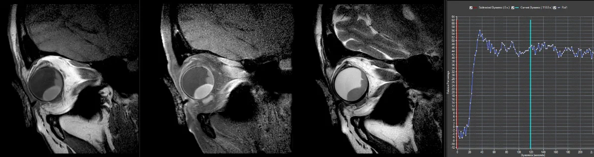PACS workstation displaying ocular MRI scans at Leiden UMC