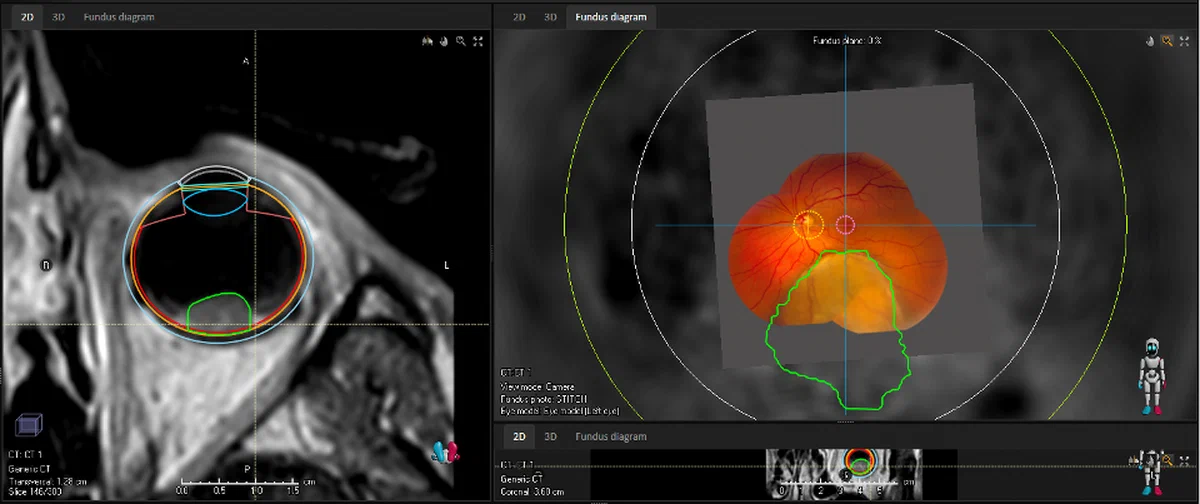 3D eye model used for MRI-guided ocular proton therapy planning