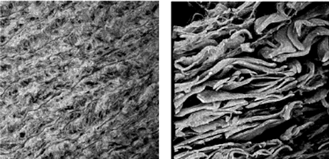 Confocal 3D reconstructions comparing normal and aneurysmal aortic wall collagen networks in Marfan syndrome and abdominal aortic aneurysm.