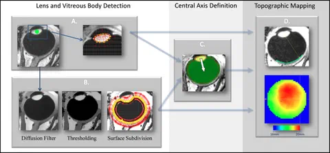 Workflow figure showing automated MRI-based retinal map generation through lens and vitreous segmentation, central-axis definition, and topographic distance mapping.