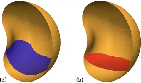 Three-dimensional views of the aqueous humor-tamponade interface shape for a filling ratio of 0.85, comparing silicone oil (a) and intraocular gas (b).