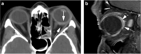 CT and MRI examples of orbital scleritis showing scleral thickening and enhancement with adjacent inflammatory changes.