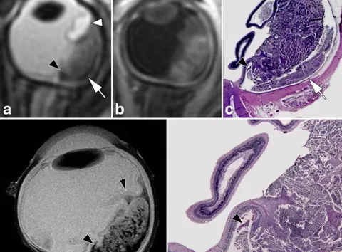 Retinoblastoma case with in vivo and ex vivo MRI and matching histopathology, illustrating retinal detachment, hemorrhagic features, and heterogeneous contrast-enhancing versus necrotic or calcified tumor regions.