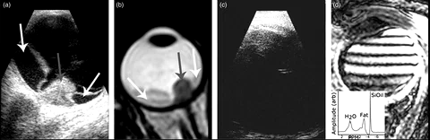 Ultrasound image showing a uveal melanoma with associated retinal detachment.