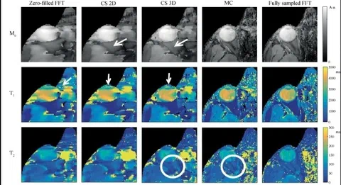Parameter maps comparing reconstruction methods, showing improved detail and lower errors with matrix completion versus zero-filled and compressed-sensing approaches.