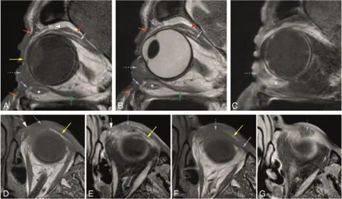 MRI of a left inferior eyelid squamous cell carcinoma invading the orbit and nearby tarsal and ligament structures.