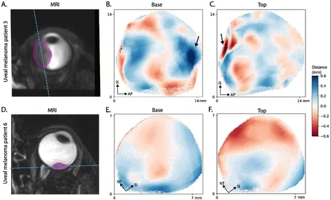 Measured tumour-surface distances for patients 3 and 6 when comparing planning and proton therapy positioning scans.