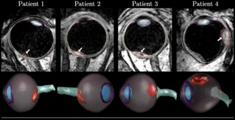 3D T1-weighted MR slices and reconstructed eyes showing segmented ocular structures and tumor.