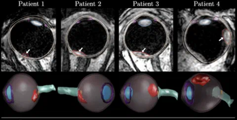 3D T1-weighted MR slices and reconstructed eyes showing segmented ocular structures and tumor.