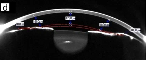 OCT image of a cornea with distantance to pIOL measurements