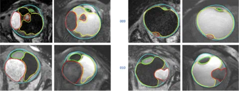Automatic MRI segmentations of ocular structures and tumor in four patients.
