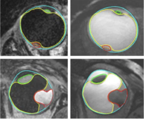 Automatic MRI segmentations of ocular structures and tumor in four patients.