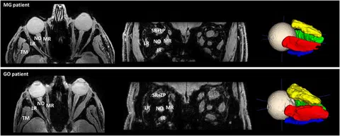 Examples of water images, fat-fraction maps, and multi-echo spin-echo outputs highlighting extra-ocular muscles in orbit MRI.