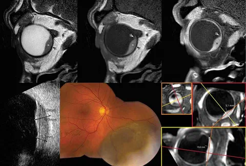 Three-dimensional patient-specific ophthalmic MRI models for proton beam therapy and refractive surgery planning.