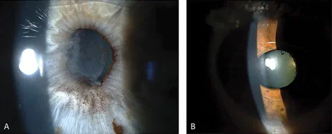 Slit lamp photographs of pigment dispersion severity in eyes with Artisan IF-pIOL.
