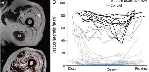 Heterogeneous fat distribution on MRI along vastus lateralis and semitendinosus muscles with region-of-interest examples.