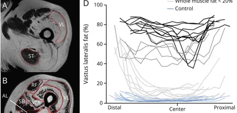 Heterogeneous fat distribution on MRI along vastus lateralis and semitendinosus muscles with region-of-interest examples.