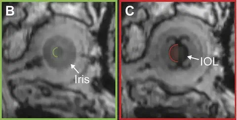 MRI scans of the eye showing the iris and the intraocular lens (IOL).