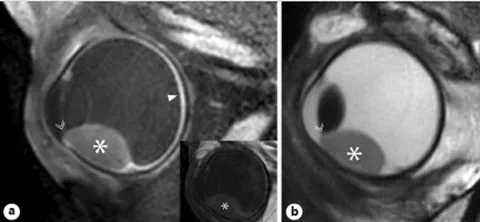 Contrast-enhanced T1-weighted and T2-weighted MRI of a uveal melanoma-containing eye showing the enhancing tumor and surrounding choroid.