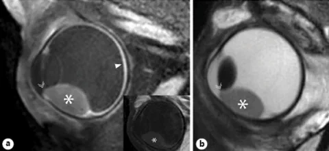 Contrast-enhanced T1-weighted and T2-weighted MRI of a uveal melanoma-containing eye showing the enhancing tumor and surrounding choroid.