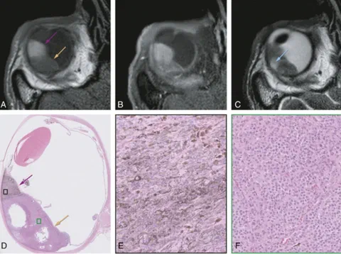 Uveal melanoma with pigmented and non-pigmented compartments on MRI, correlated with matching histopathology findings.