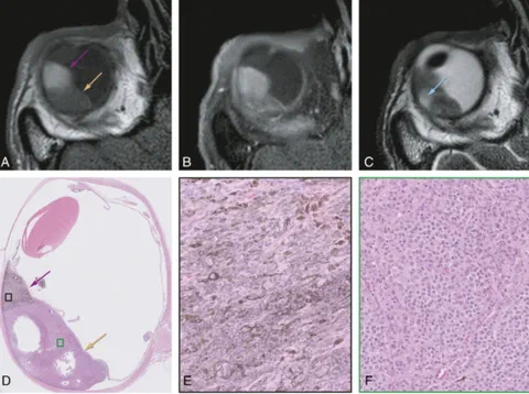 Uveal melanoma with pigmented and non-pigmented compartments on MRI, correlated with matching histopathology findings.