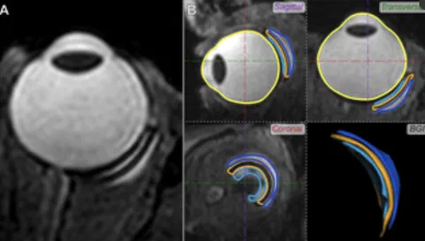 Three-dimensional MRI assessment of the Baerveldt glaucoma implant (BGI).