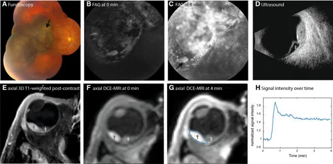 Dynamic contrast-enhanced MRI (DCE) images of uveal melanoma.