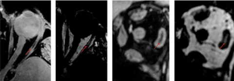 Five symptom patterns of ocular motor dysfunction linked to anatomical locations and disease classes.