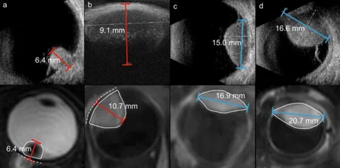 Differences between MRI-based automatic and manual prominence and largest basal diameter (LBD) measurements.