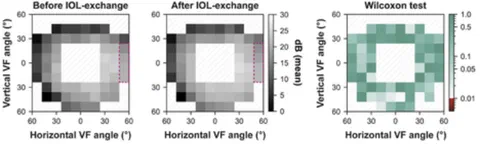 Visual field data before and after intraocular lens (IOL) exchange.
