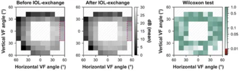 Visual field data before and after intraocular lens (IOL) exchange.