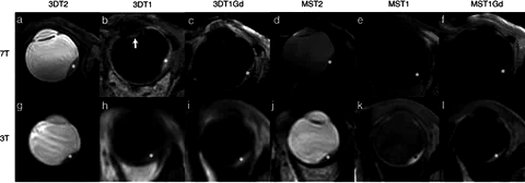 Side-by-side comparison of uveal melanoma MRI scans at 7 T and 3 T across multiple sequence types.