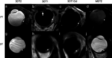 Side-by-side comparison of uveal melanoma MRI scans at 7 T and 3 T across multiple sequence types.