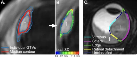 Median tumor delineation contours and local standard deviations used to determine interobserver variability across four tumor-tissue interfaces.