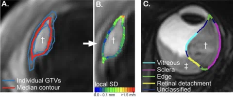 Median tumor delineation contours and local standard deviations used to determine interobserver variability across four tumor-tissue interfaces.