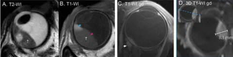 MRI of a bipartite uveal melanoma showing a melanotic (hyperintense) and amelanotic (isointense) part on T1-weighted imaging.