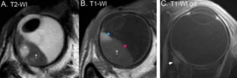 MRI of a bipartite uveal melanoma showing a melanotic (hyperintense) and amelanotic (isointense) part on T1-weighted imaging.