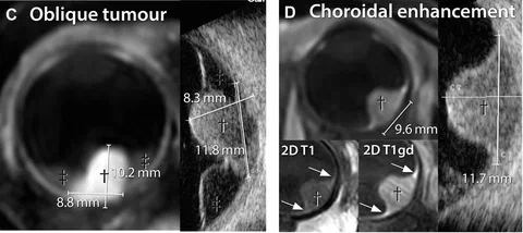 Comparison of ultrasound- and MRI-based tumor geometry measurements, with largest differences observed in anteriorly located uveal melanomas.