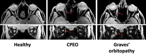 Orbital MRI water images comparing extra-ocular muscle appearance in healthy controls and patients with various neuromuscular disorders.