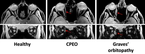 Orbital MRI water images comparing extra-ocular muscle appearance in healthy controls and patients with various neuromuscular disorders.