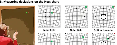 Figure showing synoptophore duction-angle measurements and Hess chart fatigue testing, with healthy and myasthenia gravis examples.