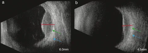 Ultrasound follow-up measurements of uveal melanoma showing longitudinal tumor size assessment after radiotherapy.
