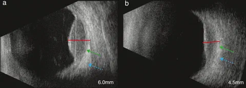 Ultrasound follow-up measurements of uveal melanoma showing longitudinal tumor size assessment after radiotherapy.
