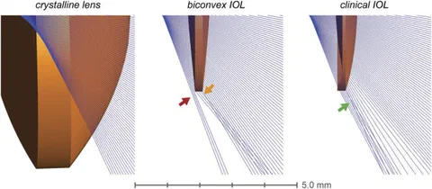 Refraction of peripheral light rays by the crystalline lens and two IOL designs, illustrating differences in peripheral retinal illumination.