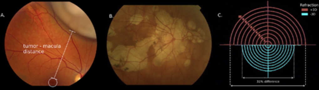 Correction Method for Optical Scaling of Fundoscopy Images: Development ...