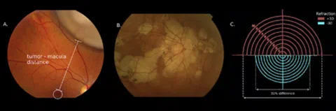 Fundus photographs illustrating an intraocular tumor and chorioretinal atrophy, with scale variation shown in phantom eyes with different refractions.